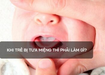 Khi trẻ bị tưa miệng thì phải làm gì?