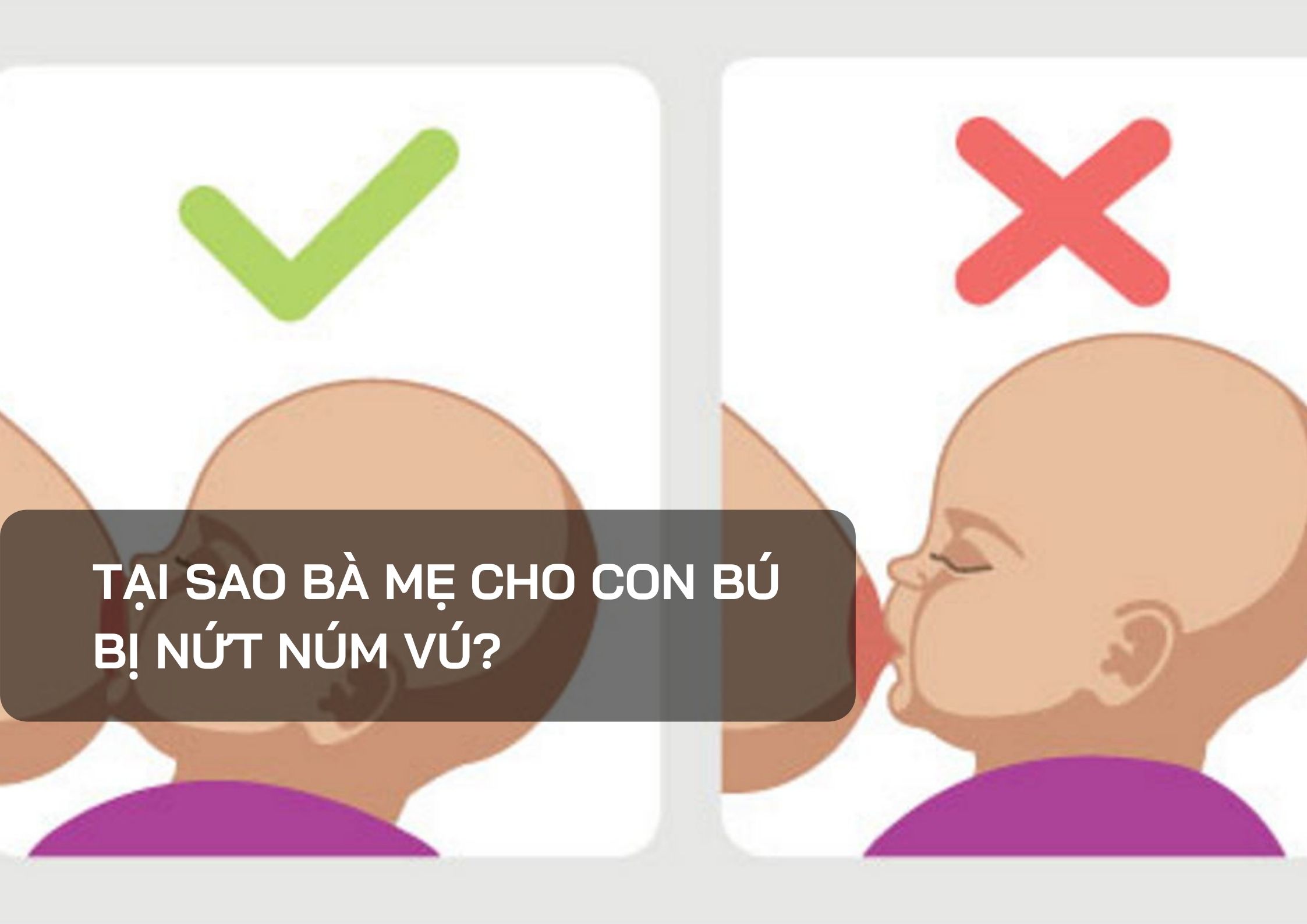 Tại sao bà mẹ cho con bú bị nứt núm vú? - AKIO JSC