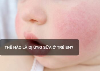 Thế nào là dị ứng sữa ở trẻ em?