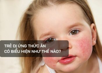 Trẻ dị ứng thức ăn có biểu hiện như thế nào?